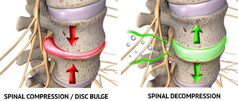 diagram to show how spinal decompression works