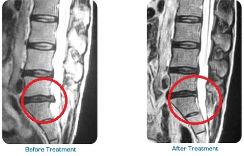 mri showing results of spinal decompression treatment