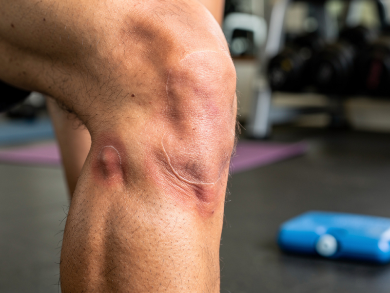 master-the-bursa-in-knee-joint-conditions-treatments-and-prevention
