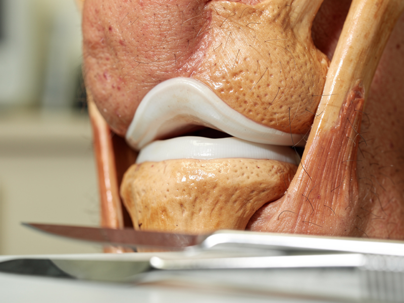 understanding-torn-meniscus-surgery-time-what-to-expect-before-during-and-after