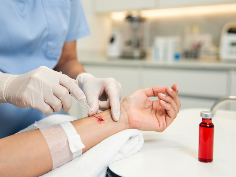 master-prp-for-arthritis-in-hands-a-step-by-step-approach