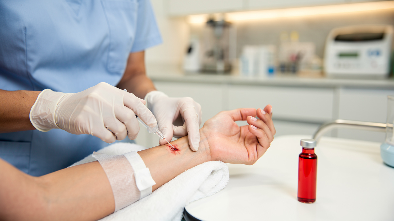 master-prp-for-arthritis-in-hands-a-step-by-step-approach